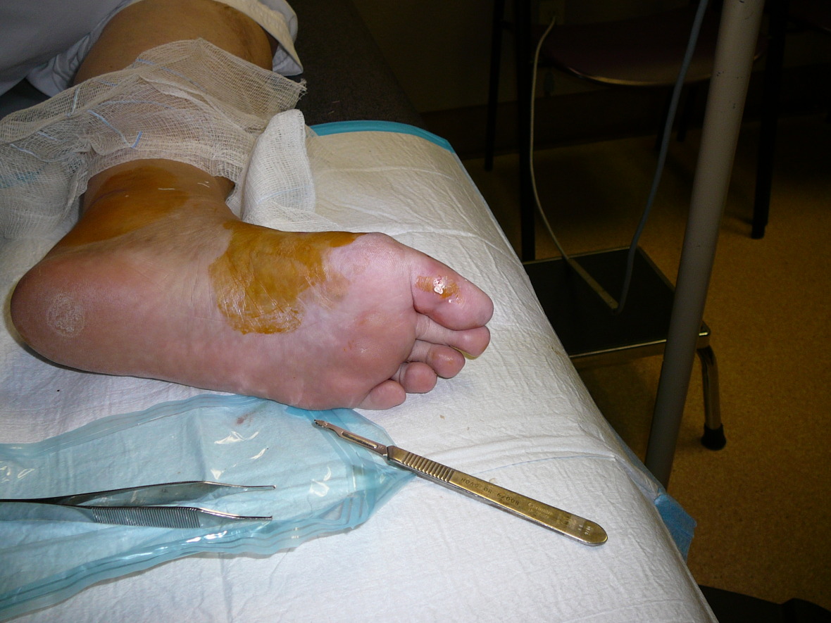 Corns On Feet likewise Nail Fungus Laser Treatment additionally ...