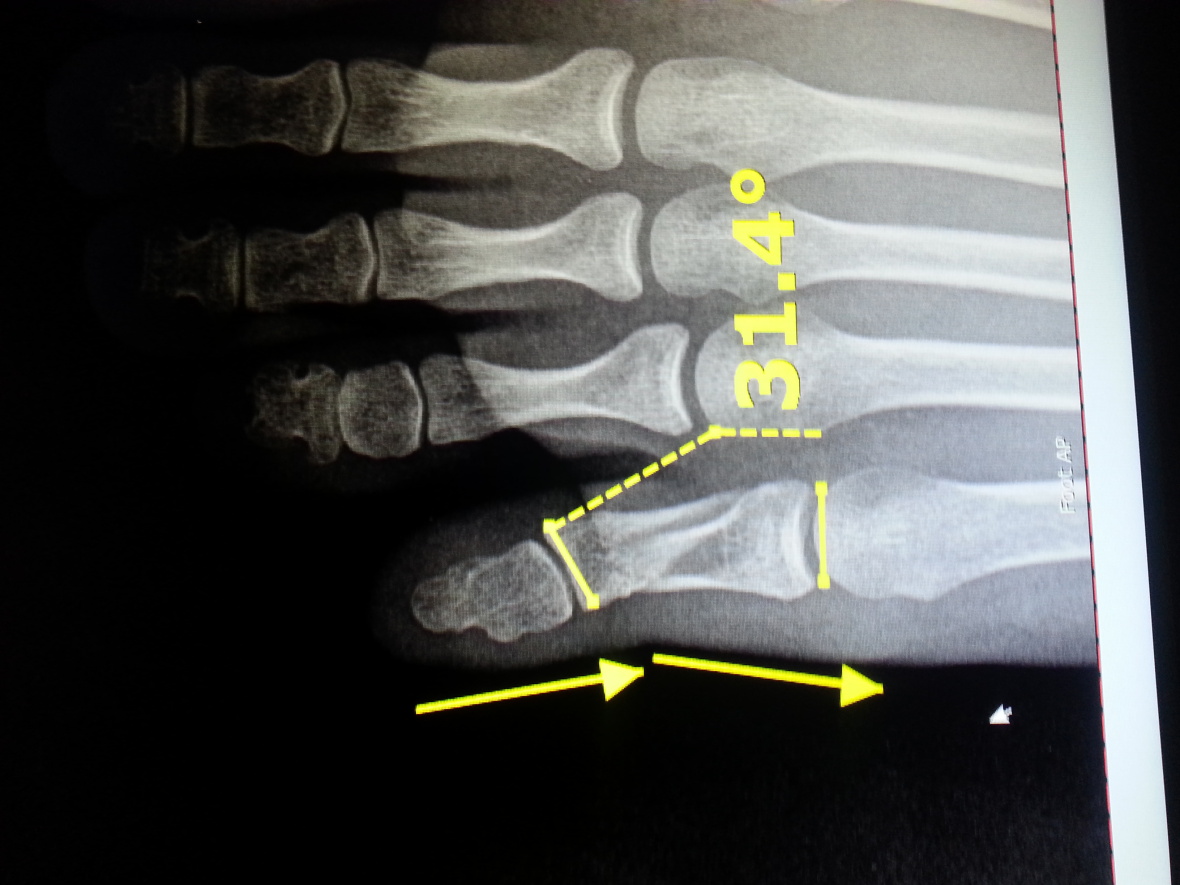 nondisplaced transverse fracture