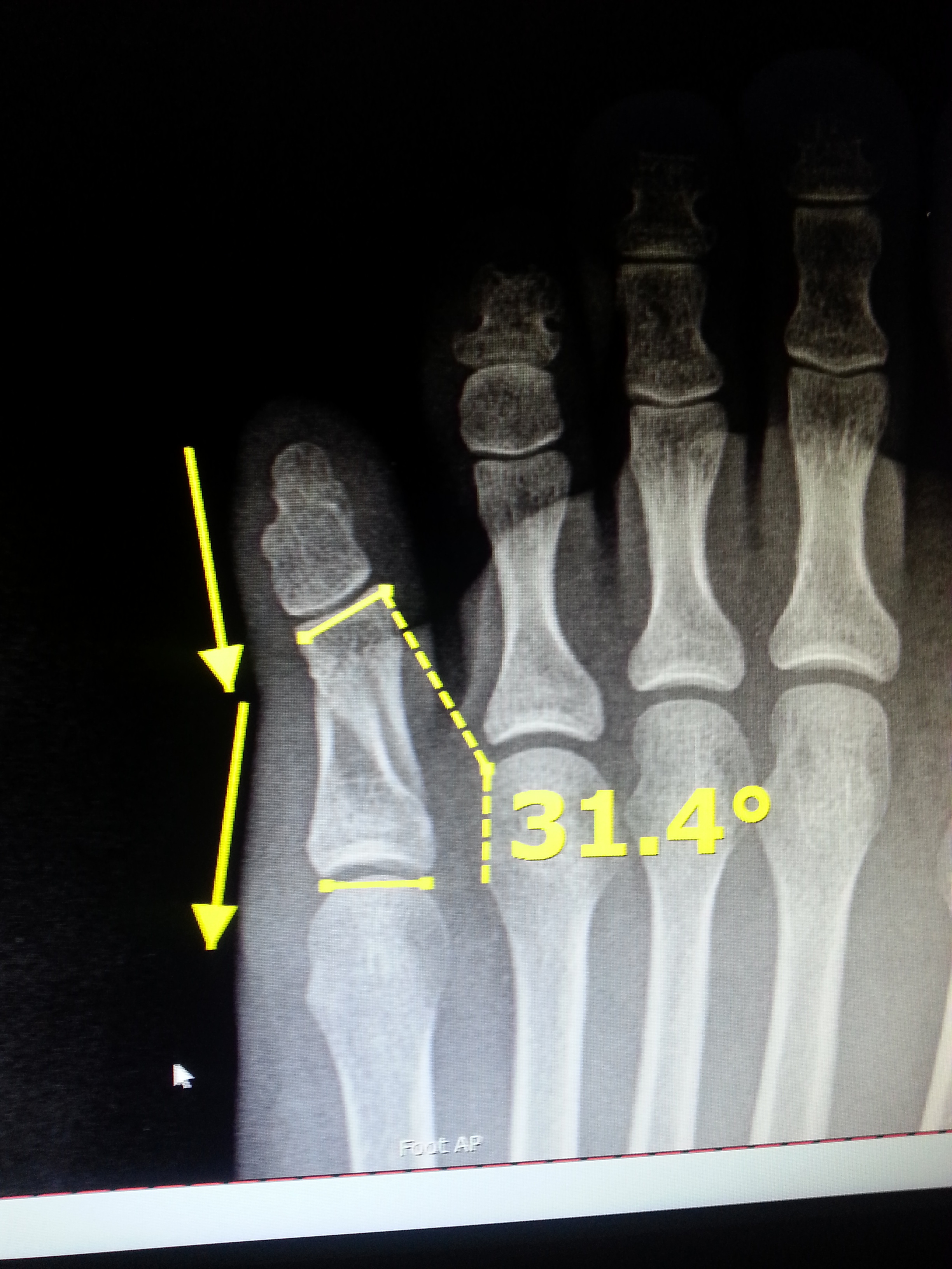 Toe Fracture Foot Doctor San Diego / La Jolla Podiatrist