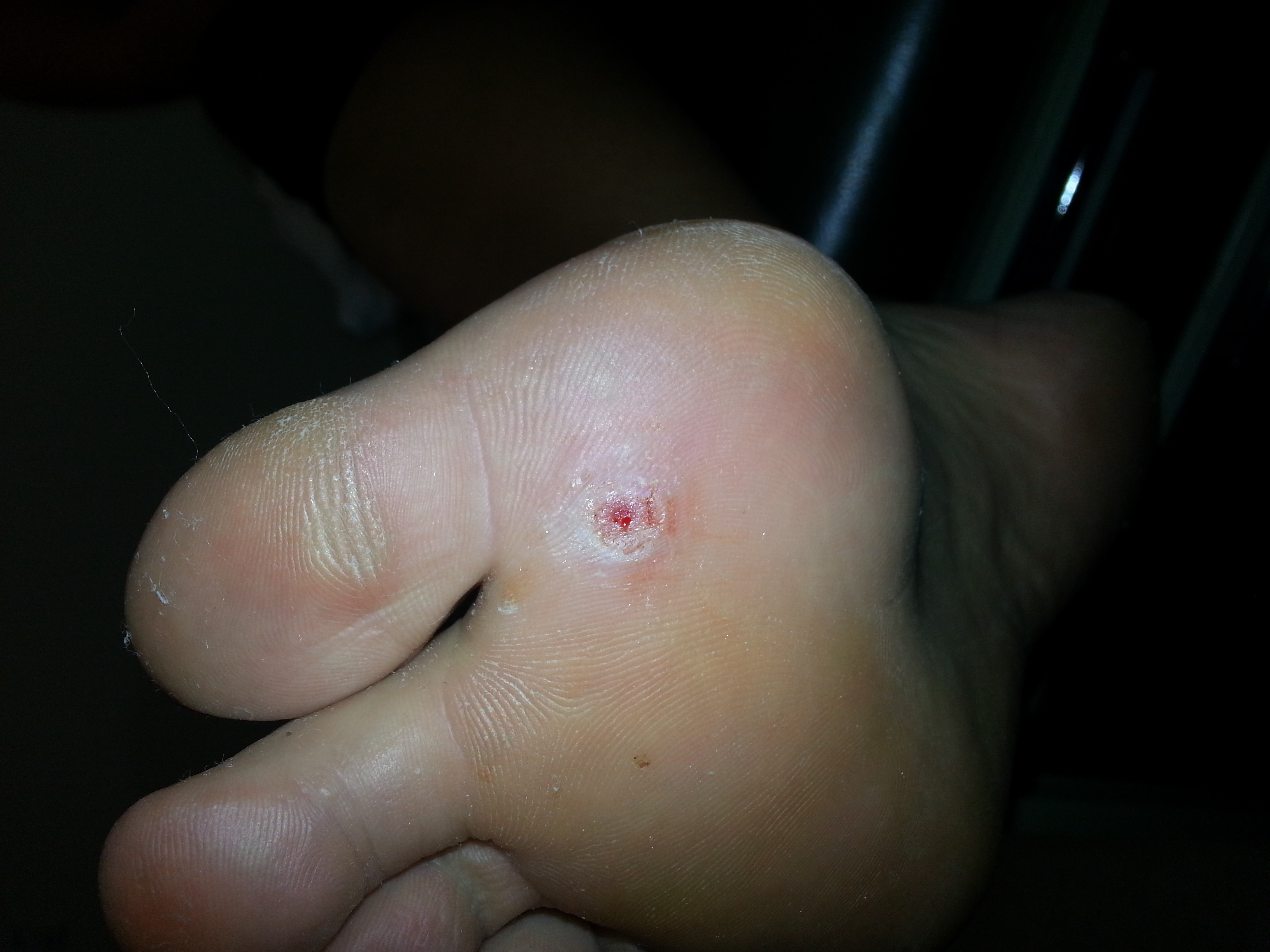 Plantars Wart Foot Doctor San Diego La Jolla Podiatrist