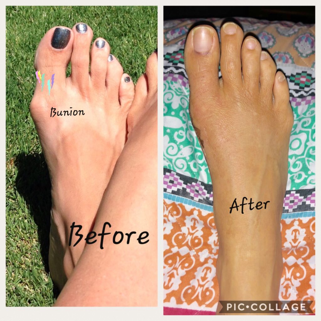 Bunion Surgery Foot Doctor San Diego / La Jolla Podiatrist