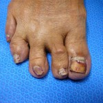 foot with toenails with a rough and discolored surface