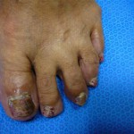 foot with thick toenails on a blue surface