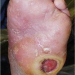 foot with dry skin and injury.