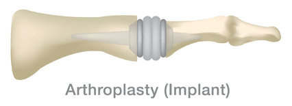 An illustration of an arthroplasty implant for hallux limitus, a condition affecting the big toe characterized by bone spurs.