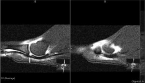 plantar plate