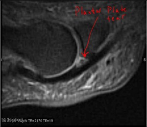 MRI showing Plantar plate tear