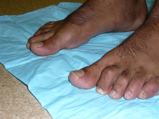 Hammer Toe for Las Cruces, NM, Mesilla Valley Footcare