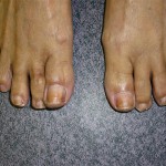 A feet with discolored toenails