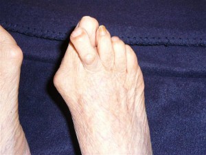 Bunion