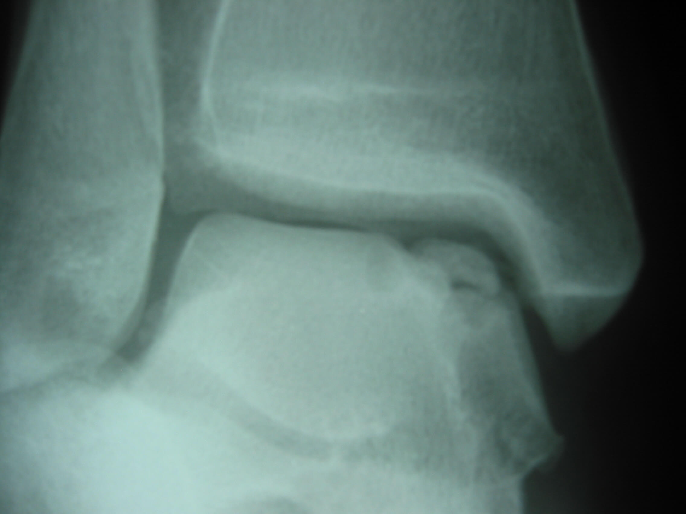 X-ray of a human knee.