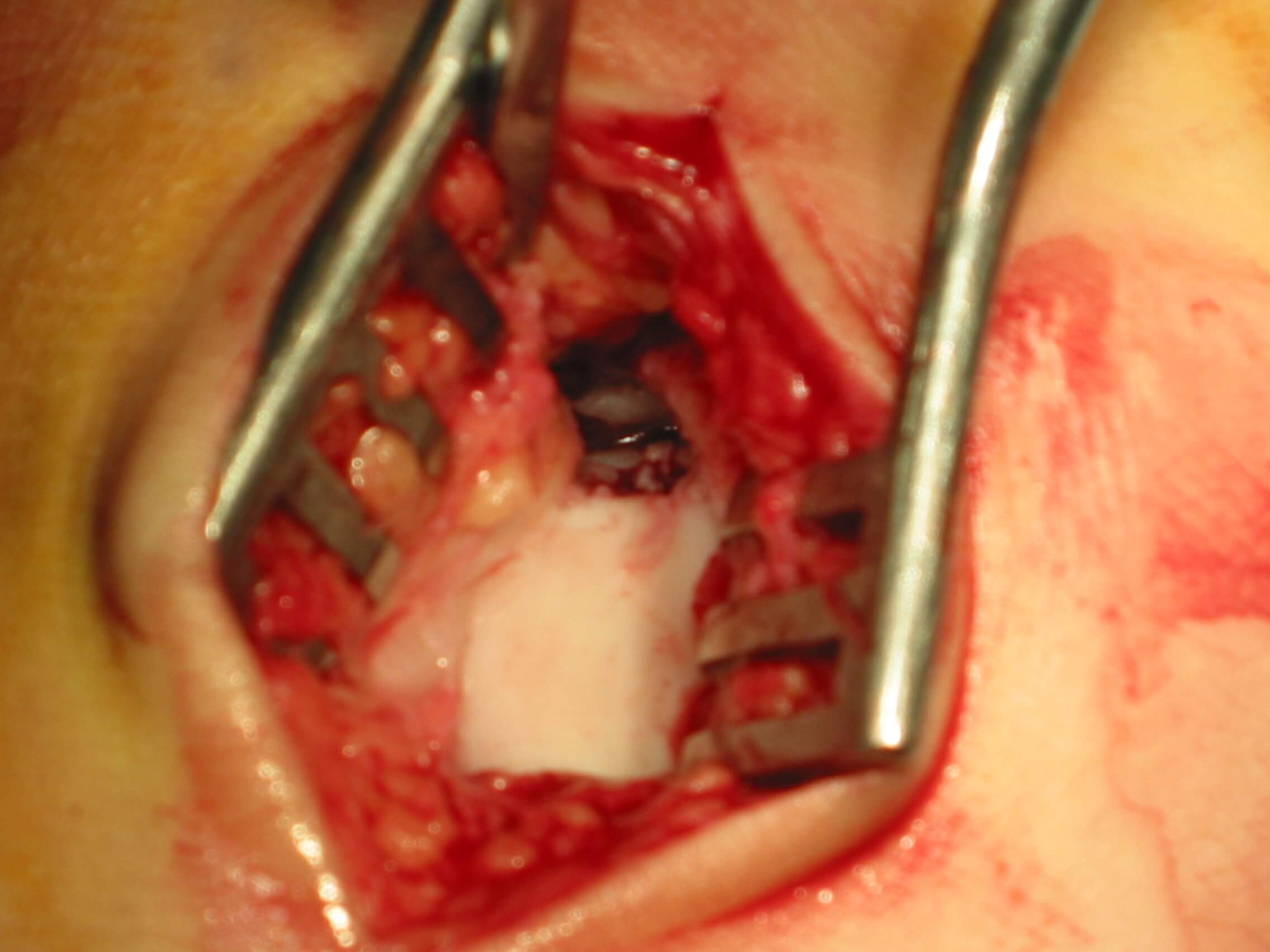 An open wound in a person's mouth.