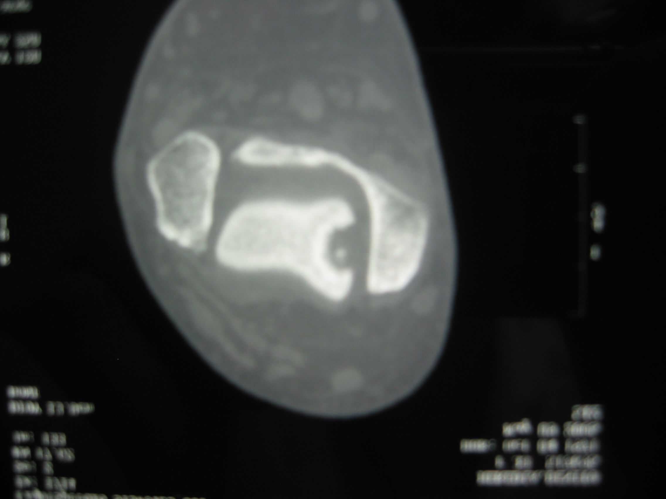 A ct scan of a patient's heart.
