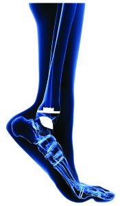 Ankle joint replacement