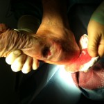 A person is carefully applying a bandage to a diabetic foot ulcer.