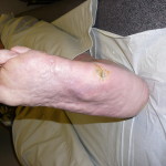 A person with a diabetic foot ulcer laying on a bed.