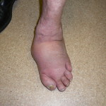 charcot foot