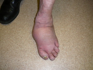 Pre surgery Charcot foot