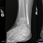 Two x-rays of the foot showing different ankle fractures.