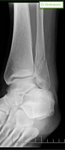 Ankle Fracture