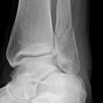 An x-ray image of an ankle fracture.