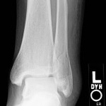 A diagnostic x-ray of an ankle injury, specifically focusing on assessing for any signs of an ankle fracture.