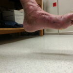 A man's Charcot foot in a hospital room.