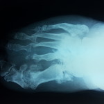 An x-ray image of a Charcot Foot.