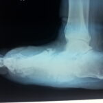 An X-ray of a Charcot foot.