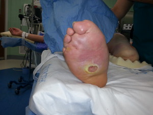 Charcot foot