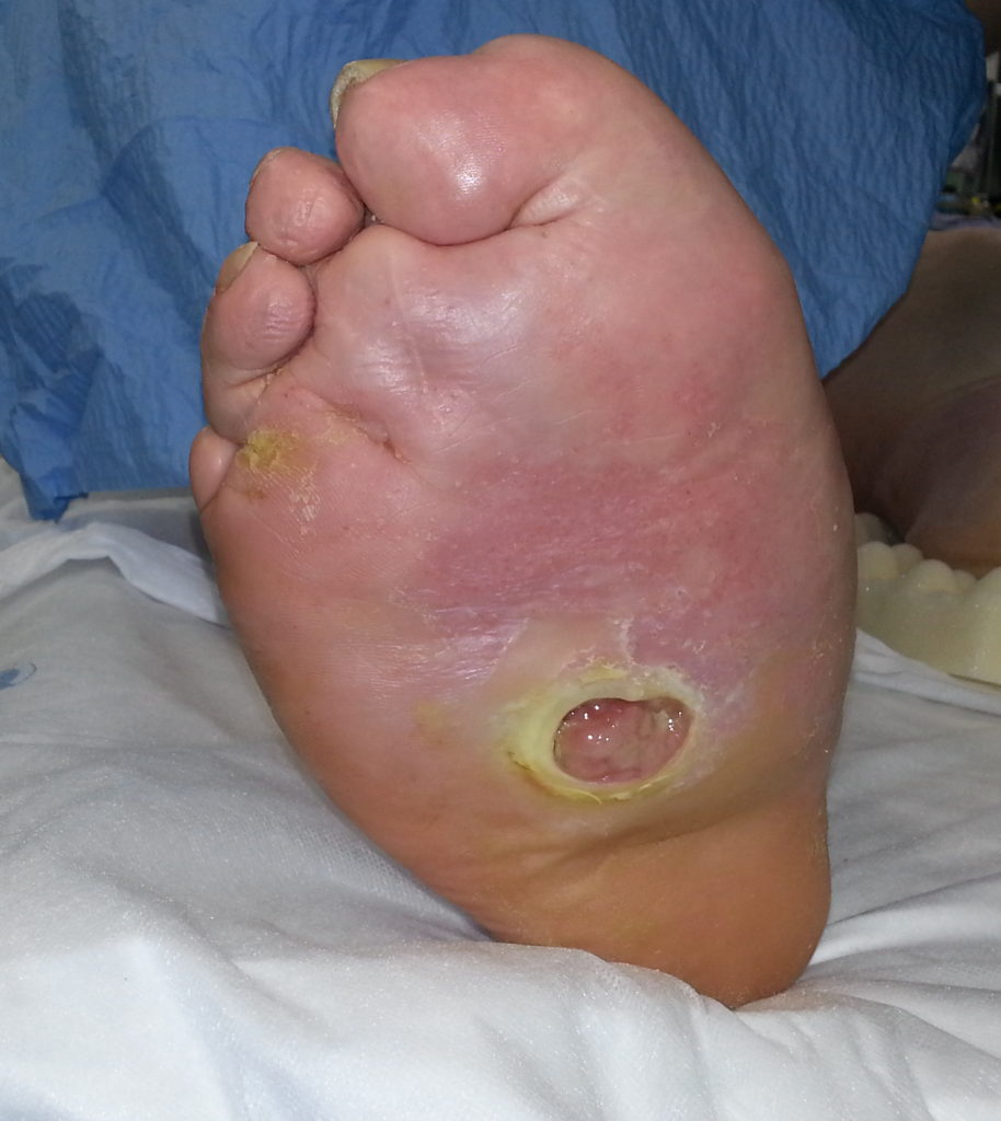 charcot foot