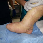 A person's foot with Charcot foot being examined in a hospital.