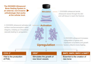 exogen bone stimulator