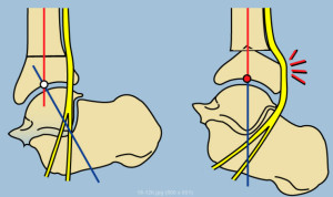 Nerve pull calcaneus