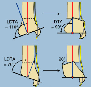 Nerve pull  tibia