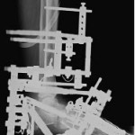 Charcot Foot Deformity Correction Post Surgery X Ray