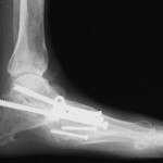 Charcot Foot Deformity Correction Post Surgery Feet