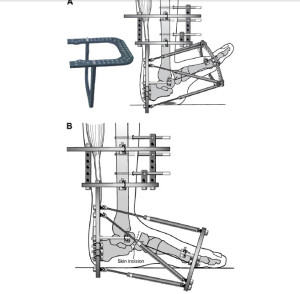 TSF charcot