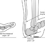 A Charcot Feet Image Diagram With Normal Diagram