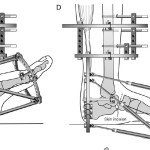Charcot Foot Deformity Correction Diagram Two