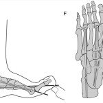 Charcot Foot Deformity Correction Diagram Three