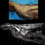 A x-ray revealing a plantar plate tear in a horse's leg.