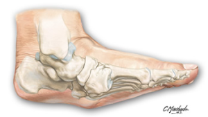 Charcot foot