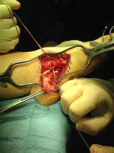 flatfoot surgery tendon transfer 