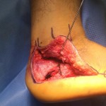 Heel Fracture