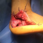 A person's foot is being operated on by a surgeon to treat a calcaneal fracture.