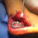 Heel Bone Fracture