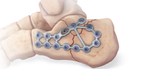 heel fracture