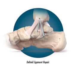 Deltoid Ligament Foot