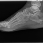 An x-ray of a person's foot revealing a calcaneal fracture.